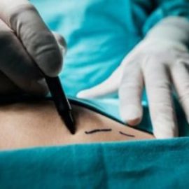 انتخاب بهترین پزشک جراحی چاقی معده در تهران و بررسی 2 روش اسلیو و بای پس معده