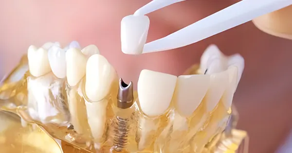 آیا کاشت دندان با ایمپلنت فرق دارد؟
